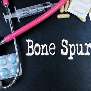 Bone Spurs – Causes, Types, and Management Options