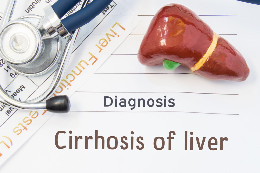 Liver Cirrhosis – Its Stages and Prevention