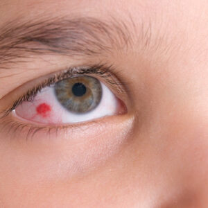 Eye infections – All you need to know