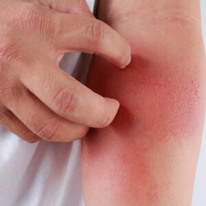 Here’s How to Identify a Skin Rash